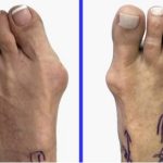 bunions treatments houston