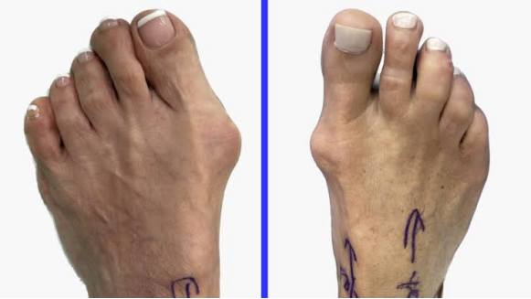 bunions treatments houston
